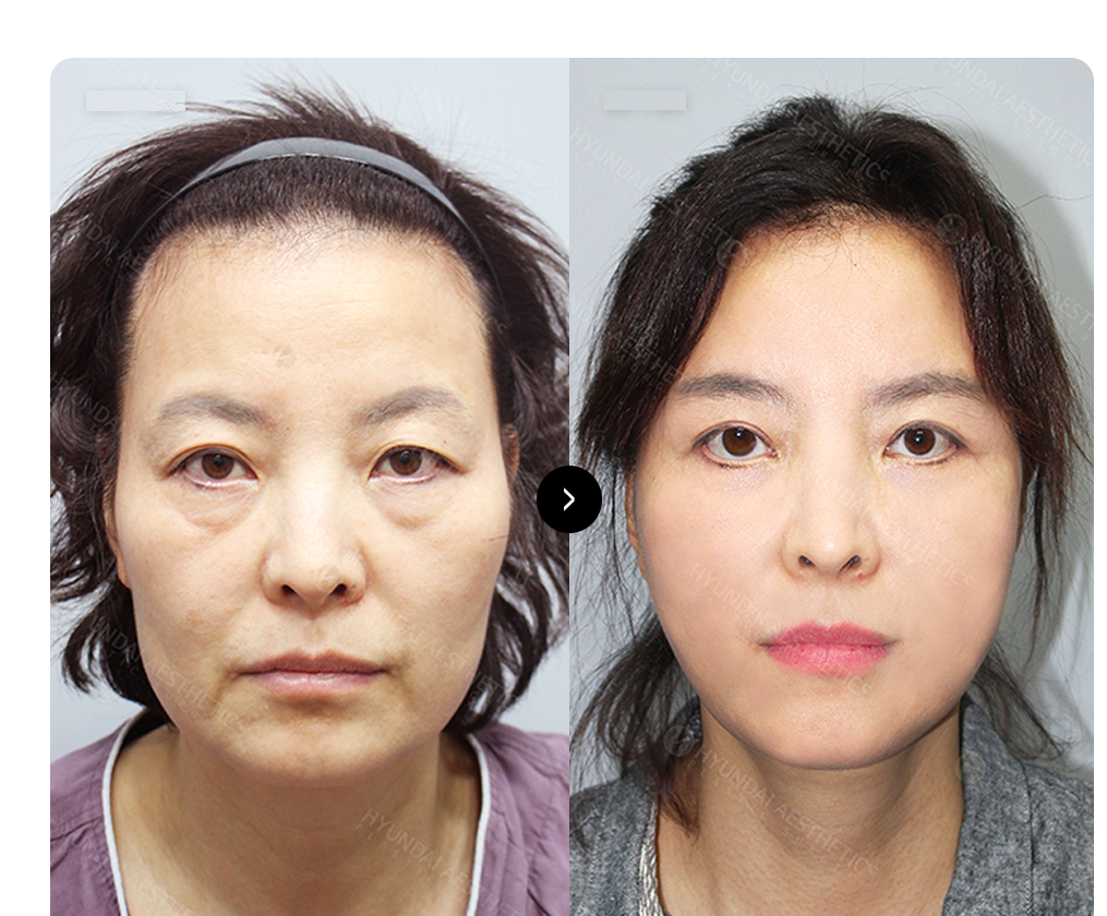 SMAS нүүр өргөх мэс засал BEFORE & AFTER: мэс заслын өмнө ба дараах харьцуулалт