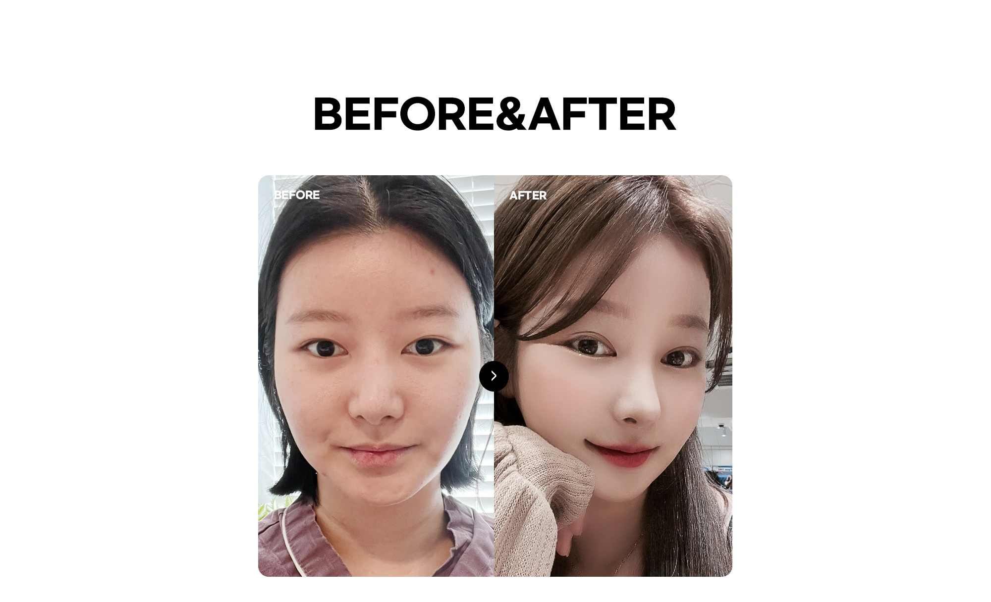 Залуу төрхийн өөх шилжүүлэн суулгалтын BEFORE & AFTER харьцуулсан зураг