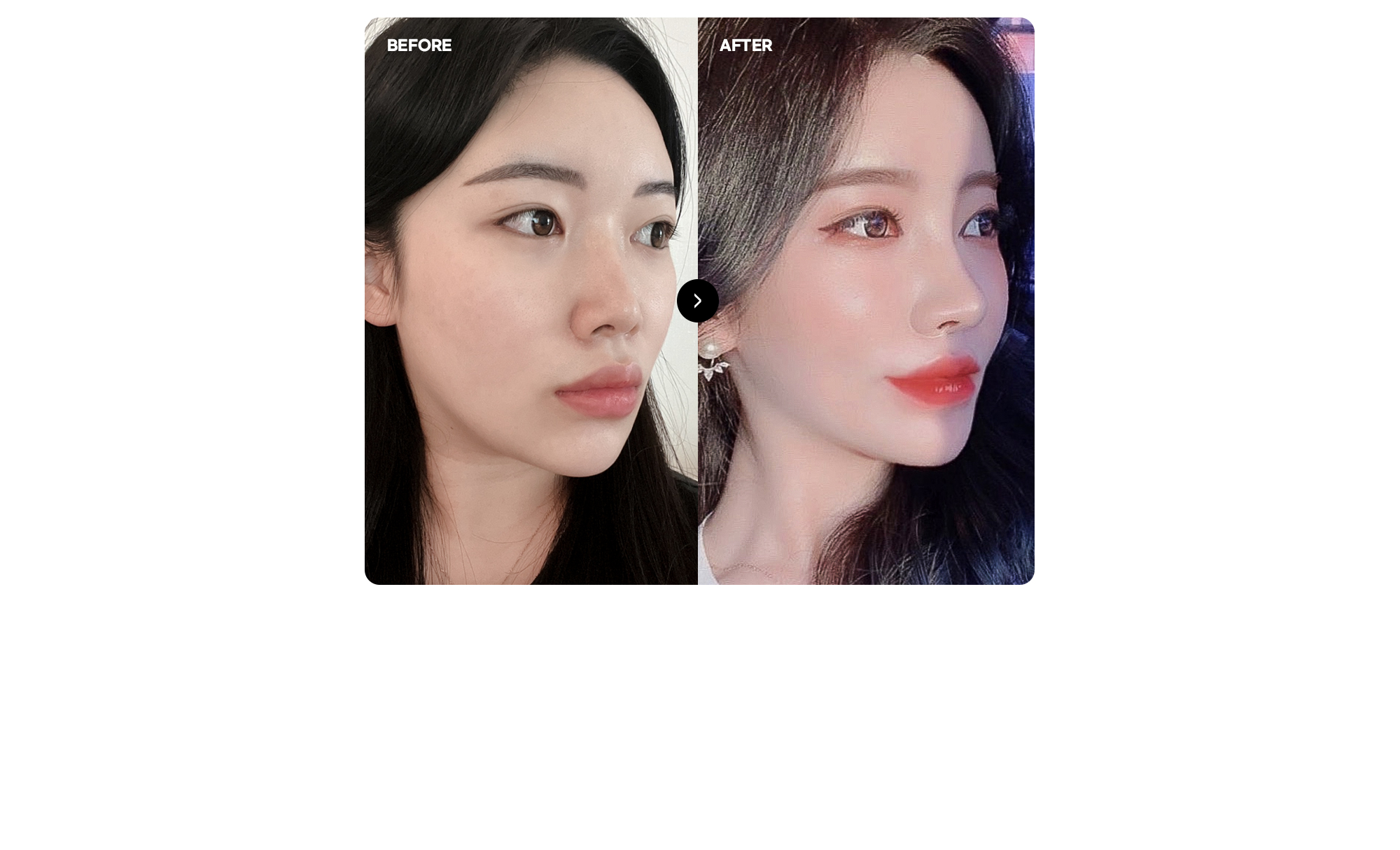 Залуу төрхийн өөх шилжүүлэн суулгалтын BEFORE & AFTER харьцуулсан зураг: Hyundai эмнэлэгт мэс засал хийлгэсэн бодит өвчтөн