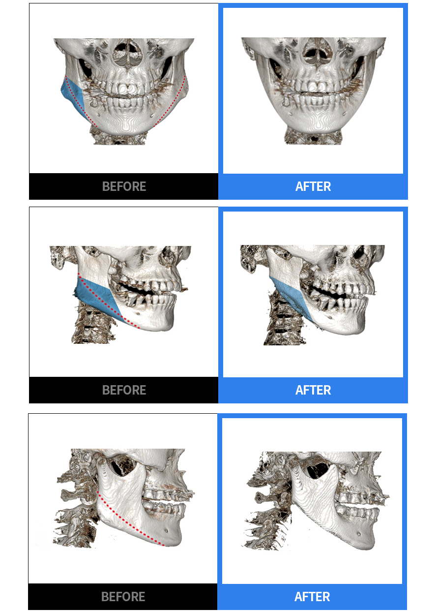 Дөрвөлжин эрүү багасгахын өмнө ба дараах урд, хажуу талын BEFORE / AFTER CT харьцуулалт