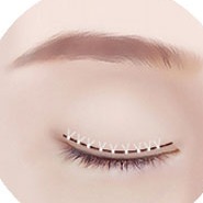 Зүсэлттэй давхрааны мэс заслын STEP 03 бэхлэх, оёх үе шатны зураглал